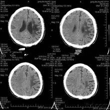 ভালো দাম KND-DRYTEC-3000 লেজার প্রিন্টারের জন্য 28 সেমি * 35 সেমি মেডিকেল ফিল্মের এক্স্রে পেপার অনলাইন