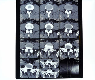 Good price 8 ইন * 10in 14in * 17in উচ্চ ঘনত্বের মেডিকেল এক্স-রে শুকনো তাপীয় প্রিন্টার ফিল্ম অনলাইন